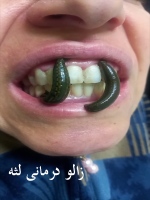 زالو درمانی عفونت لثه